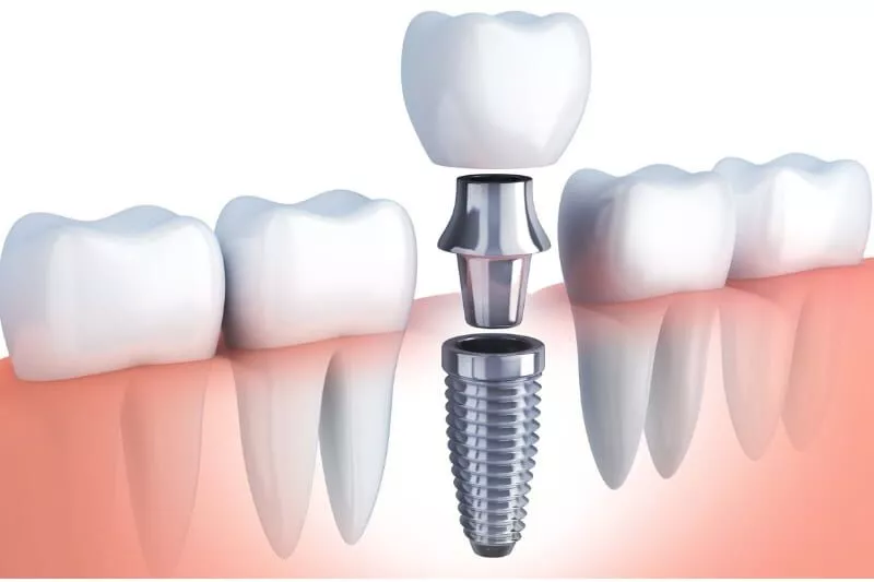 Dental Implant Dubai Price