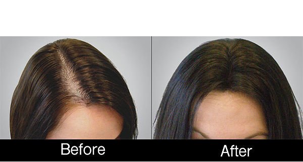 PRP Treatment for Hair in Dubai
