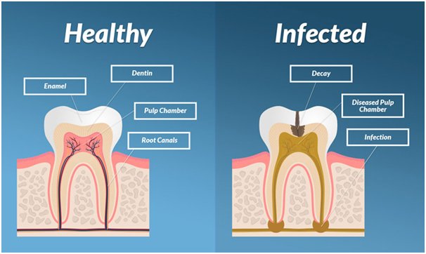 Painless RCT Treatment in Dubai