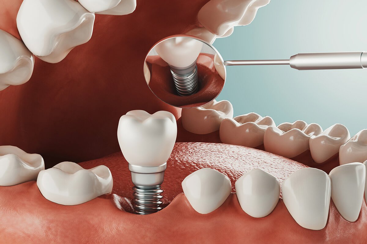 Same Day Dental Implants