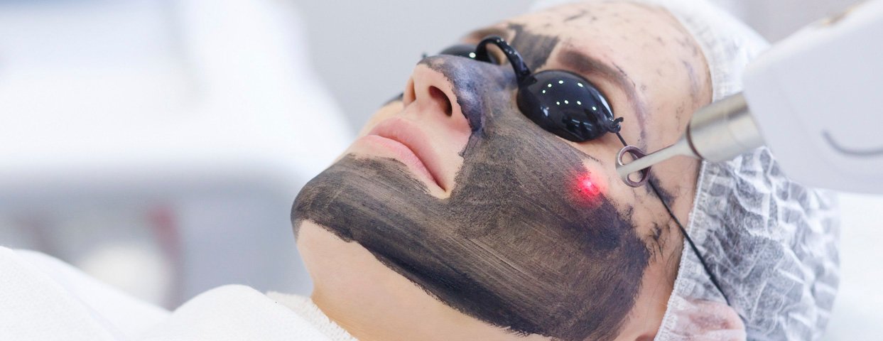 Carbon Laser Treatment