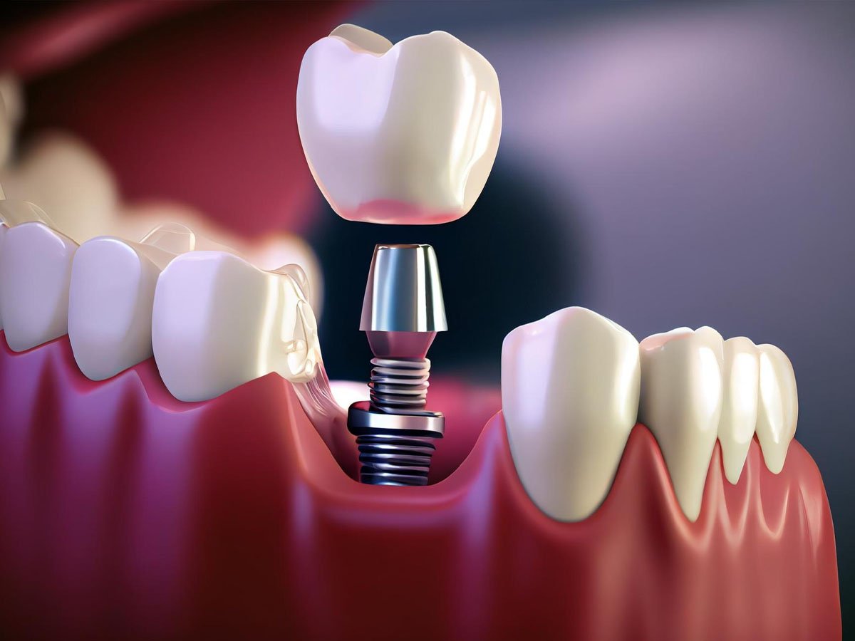 Dental Implants Treatment Dubai