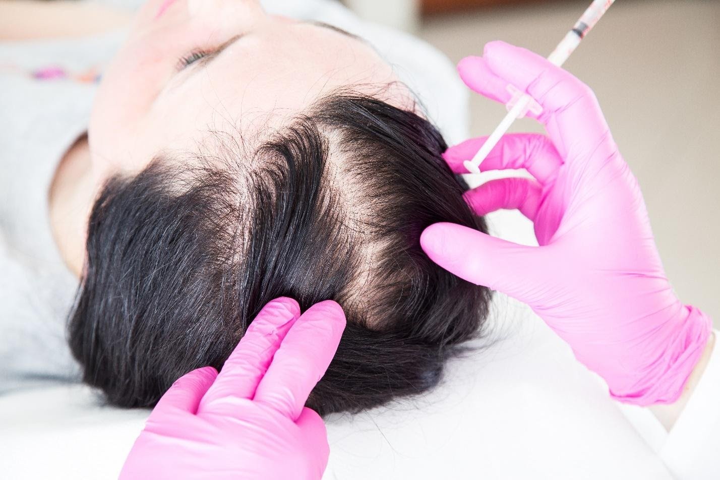 PRP Treatment For Hair In Dubai